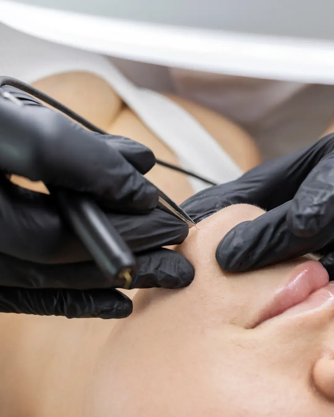 Hirsutisme chez la femme : causes, bilan et solutions pour réduire durablement la pilosité