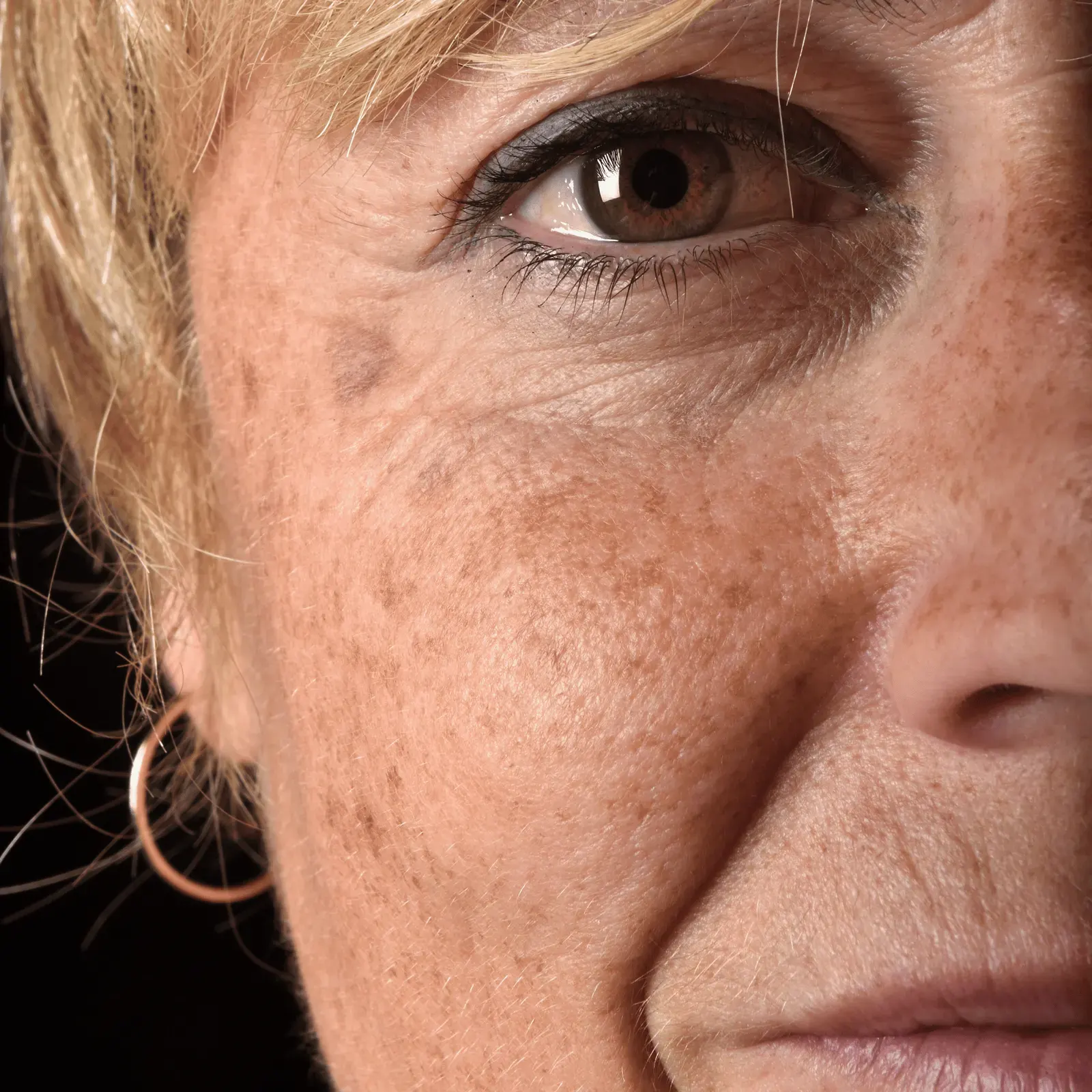 Taches pigmentaires : Quel traitement choisir ?
