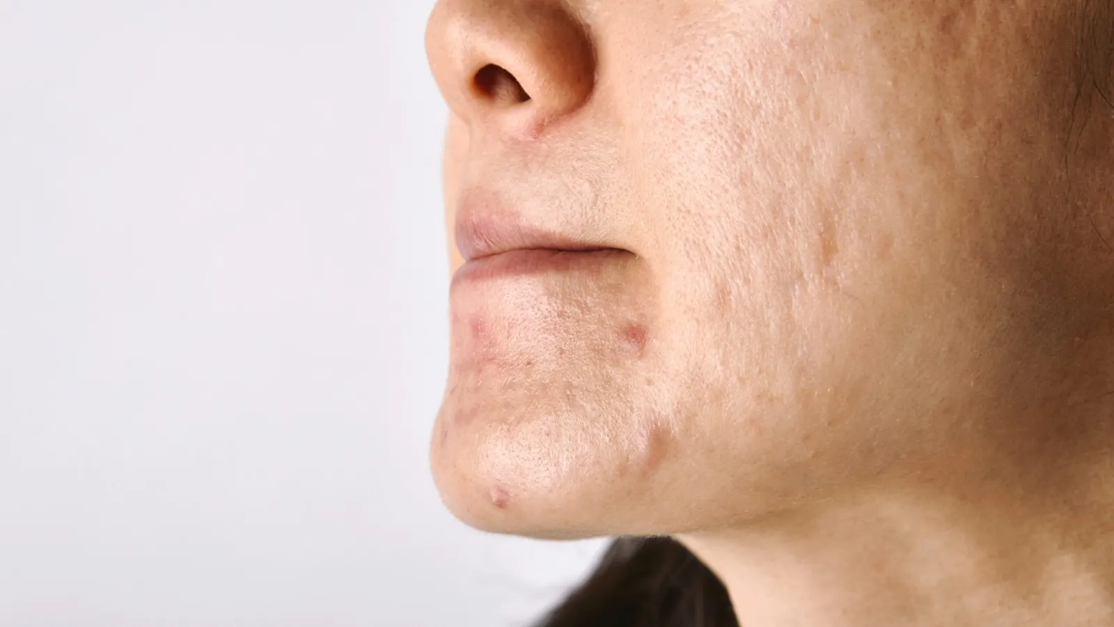 Cicatrices d’acné : Prévenir, traiter et améliorer l’apparence de votre peau