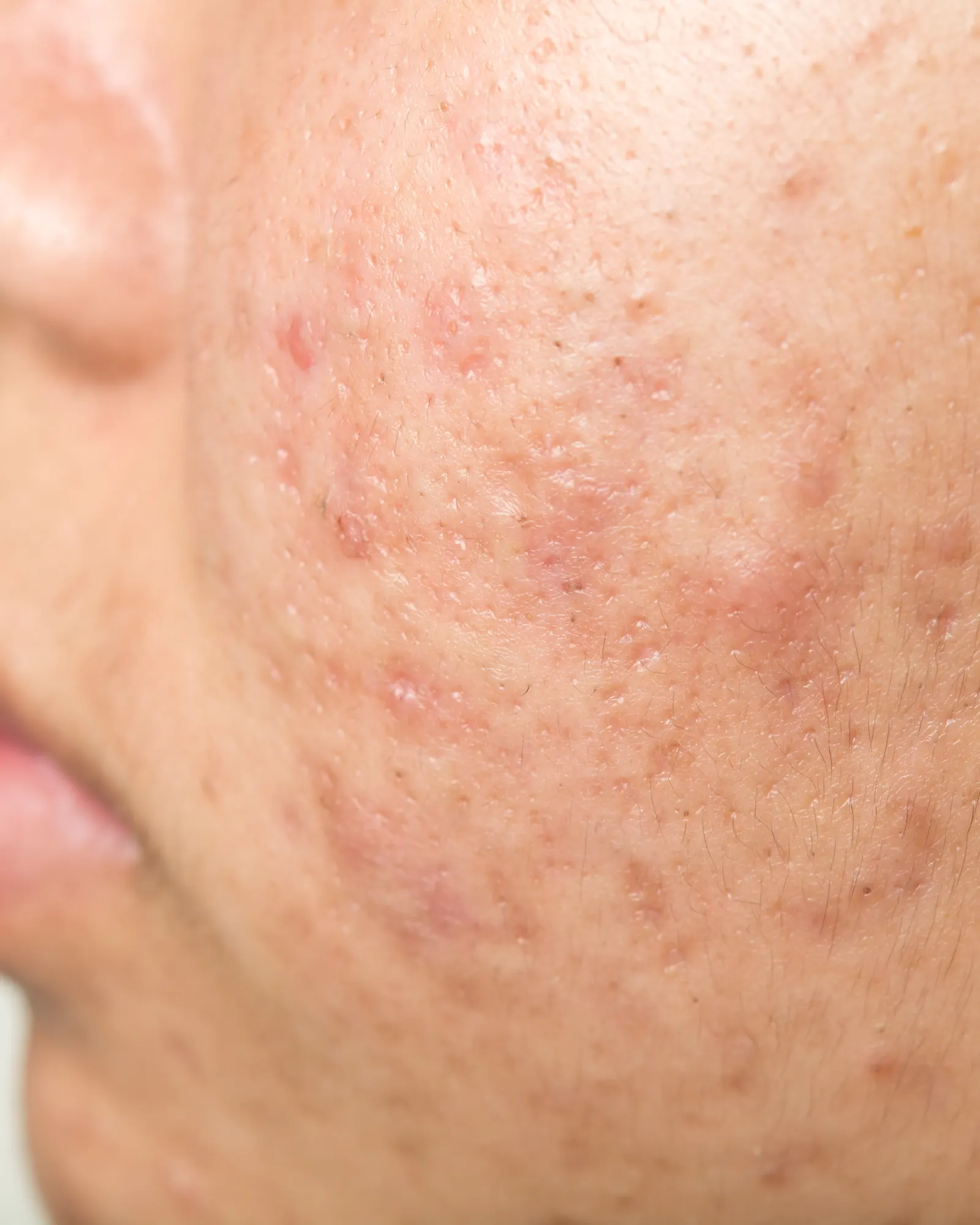 L’acné inflammatoire : causes, traitements et solutions efficaces
