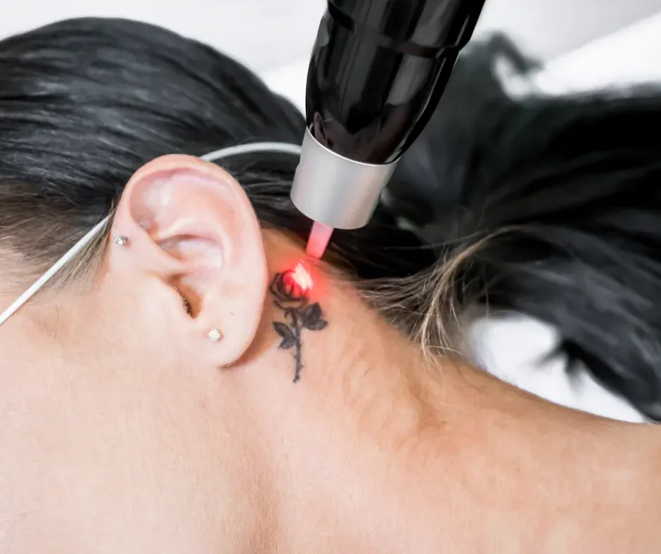 Laser enlevant un tatouage sur le cou d’une femme