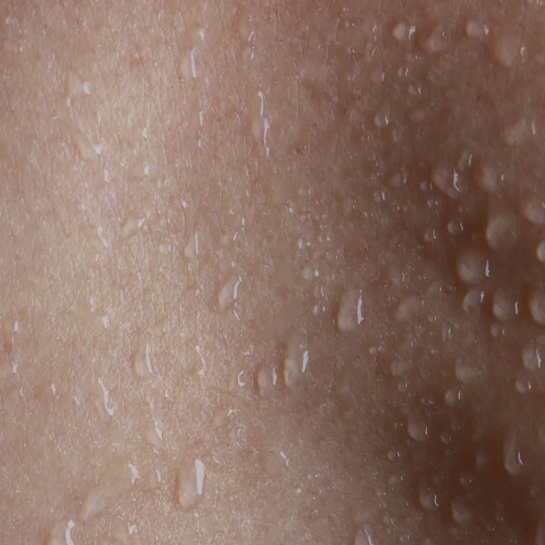 Gouttes de sueur liées à une transpiration excessive